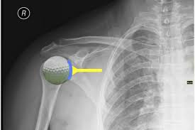 golf ball shoulder