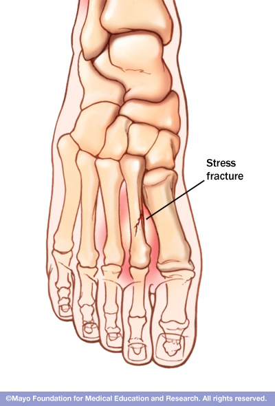 stress fracture treatment