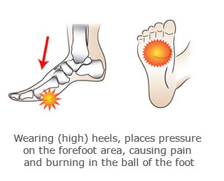 foot pain, mortons neuroma physio ashburton