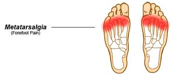 matatarsalgia foot pain physio