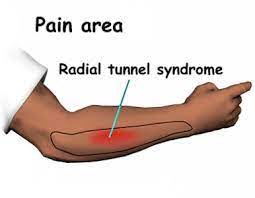 Radial Tunnel Syndrome: A less common cause of lateral elbow pain